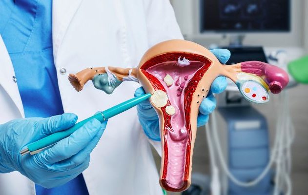 Fibroids